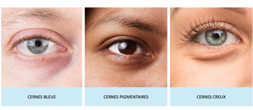 cernes et poches sous les yeux